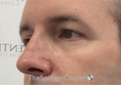 Tear Trough / Under Eye Fillers Before & After Gallery - Patient 273099 - Image 3