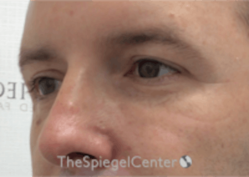 Tear Trough / Under Eye Fillers Before & After Gallery - Patient 273099 - Image 4