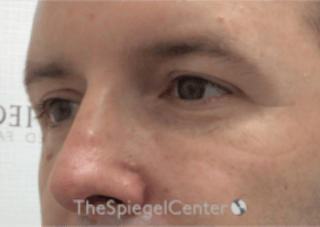 Tear Trough / Under Eye Fillers Before & After Gallery - Patient 273099 - Image 4
