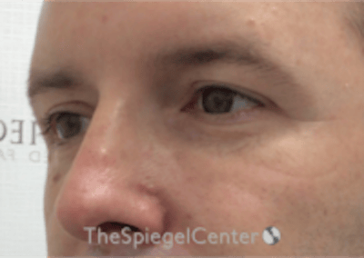 Tear Trough / Under Eye Fillers Before & After Gallery - Patient 273099 - Image 4