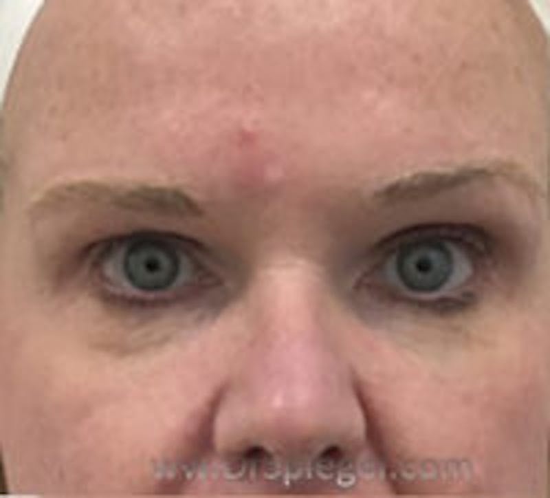 Tear Trough / Under Eye Fillers Before & After Gallery - Patient 358977 - Image 1