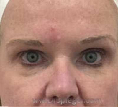 Tear Trough / Under Eye Fillers Before & After Gallery - Patient 358977 - Image 1