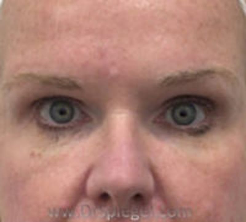 Tear Trough / Under Eye Fillers Before & After Gallery - Patient 358977 - Image 2