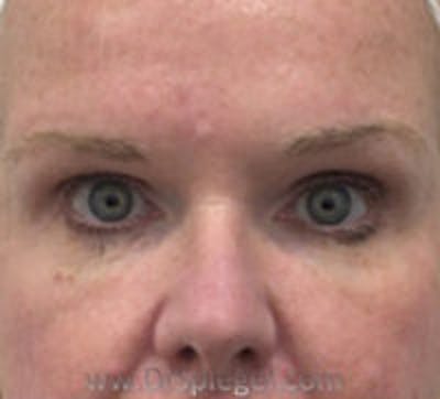 Tear Trough / Under Eye Fillers Before & After Gallery - Patient 358977 - Image 2