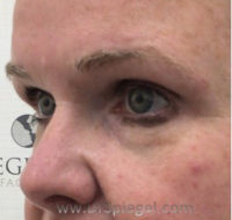 Tear Trough / Under Eye Fillers Before & After Gallery - Patient 358977 - Image 3