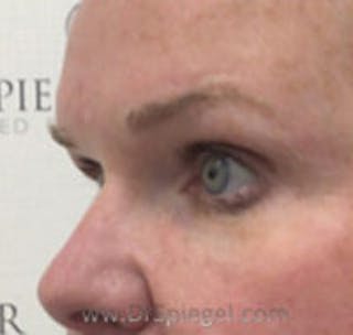 Tear Trough / Under Eye Fillers Before & After Gallery - Patient 358977 - Image 4