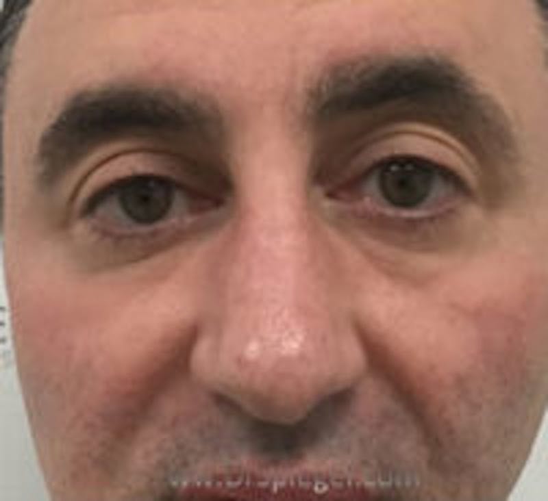 Tear Trough / Under Eye Fillers Before & After Gallery - Patient 114233 - Image 1