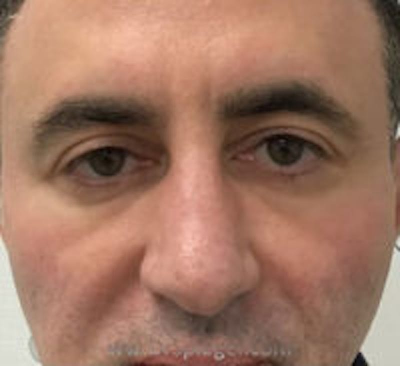 Tear Trough / Under Eye Fillers Before & After Gallery - Patient 114233 - Image 2