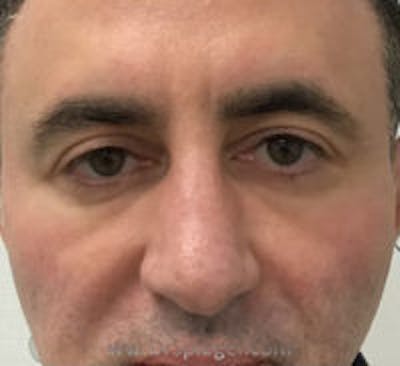 Tear Trough / Under Eye Fillers Before & After Gallery - Patient 114233 - Image 2