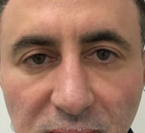 Tear Trough / Under Eye Fillers Before & After Gallery - Patient 114233 - Image 2