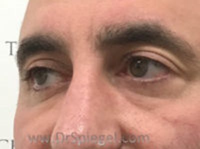 Tear Trough / Under Eye Fillers Before & After Gallery - Patient 114233 - Image 3