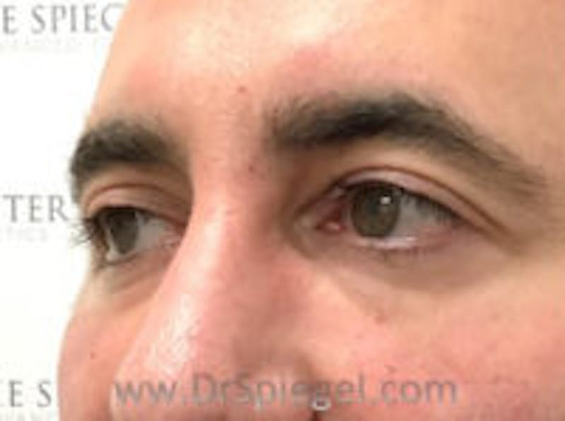 Tear Trough / Under Eye Fillers Before & After Gallery - Patient 114233 - Image 4