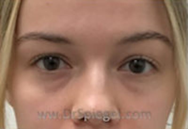Tear Trough / Under Eye Fillers Before & After Gallery - Patient 428396 - Image 1