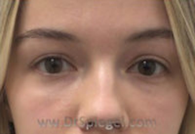 Tear Trough / Under Eye Fillers Before & After Gallery - Patient 428396 - Image 2