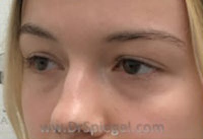 Tear Trough / Under Eye Fillers Before & After Gallery - Patient 428396 - Image 3