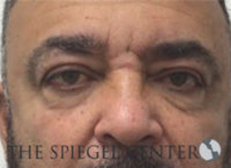 Tear Trough / Under Eye Fillers Before & After Gallery - Patient 235960 - Image 1