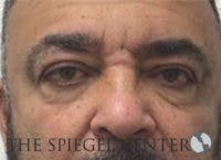 Tear Trough / Under Eye Fillers Before & After Gallery - Patient 235960 - Image 1