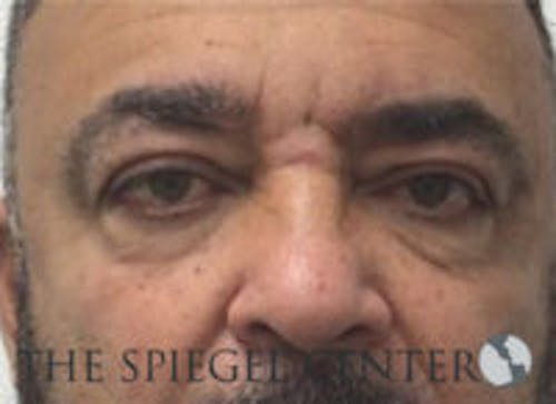Tear Trough / Under Eye Fillers Before & After Gallery - Patient 235960 - Image 1