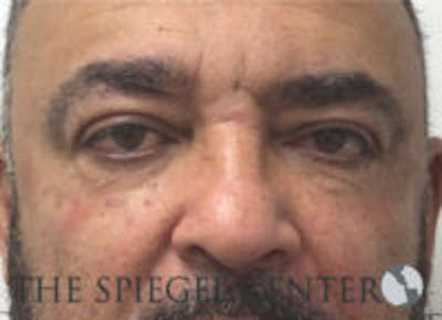 Tear Trough / Under Eye Fillers Before & After Gallery - Patient 235960 - Image 2