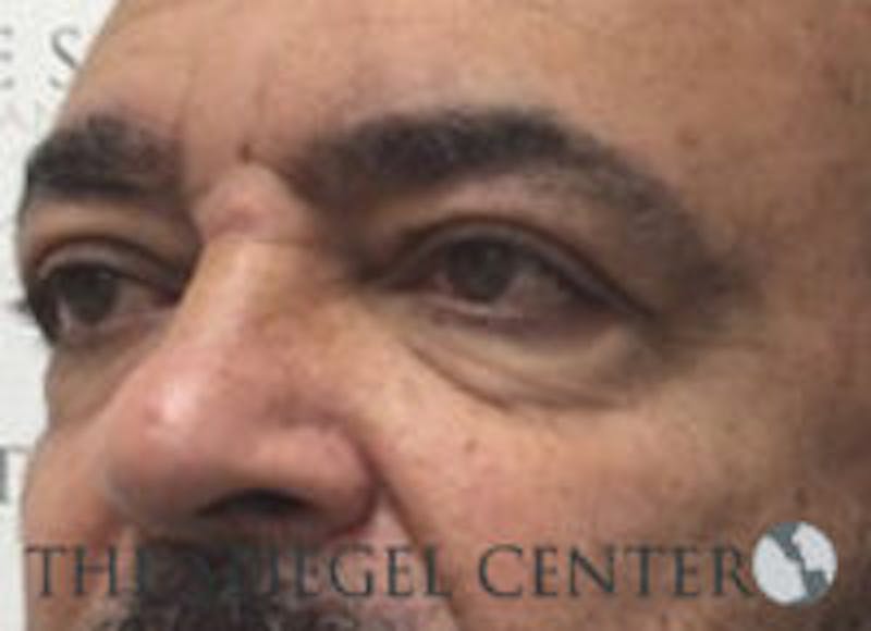 Tear Trough / Under Eye Fillers Before & After Gallery - Patient 235960 - Image 3