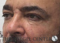 Tear Trough / Under Eye Fillers Before & After Gallery - Patient 235960 - Image 4