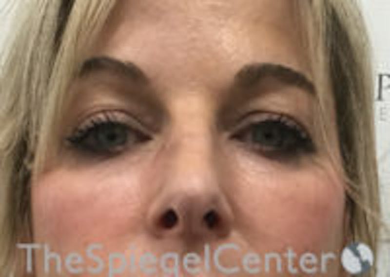 Tear Trough / Under Eye Fillers Before & After Gallery - Patient 593202 - Image 1