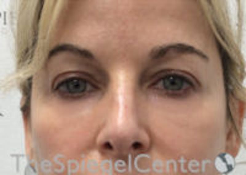 Tear Trough / Under Eye Fillers Before & After Gallery - Patient 593202 - Image 2