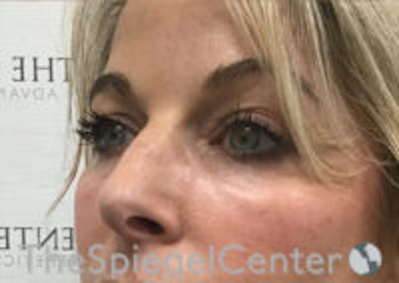 Tear Trough / Under Eye Fillers Before & After Gallery - Patient 593202 - Image 3