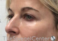 Tear Trough / Under Eye Fillers Before & After Gallery - Patient 593202 - Image 4