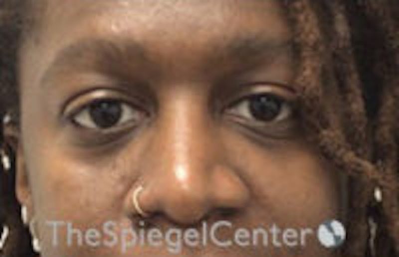 Tear Trough / Under Eye Fillers Before & After Gallery - Patient 316228 - Image 1