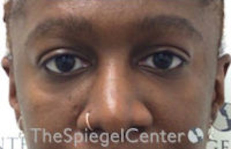 Tear Trough / Under Eye Fillers Before & After Gallery - Patient 316228 - Image 2