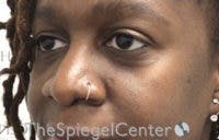 Tear Trough / Under Eye Fillers Before & After Gallery - Patient 316228 - Image 3