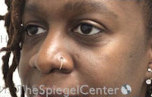 Tear Trough / Under Eye Fillers Before & After Gallery - Patient 316228 - Image 3