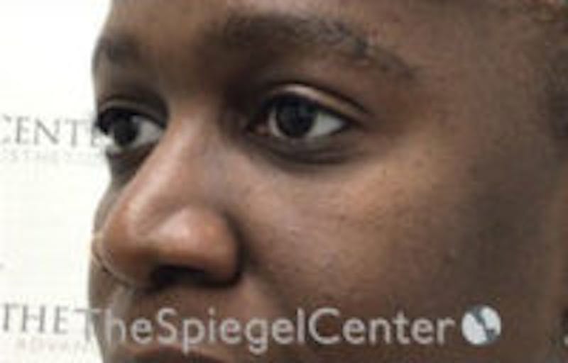 Tear Trough / Under Eye Fillers Before & After Gallery - Patient 316228 - Image 4