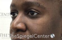 Tear Trough / Under Eye Fillers Before & After Gallery - Patient 316228 - Image 4