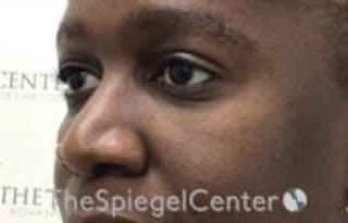 Tear Trough / Under Eye Fillers Before & After Gallery - Patient 316228 - Image 4