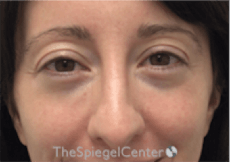 Tear Trough / Under Eye Fillers Before & After Gallery - Patient 254266 - Image 1