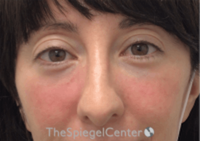 Tear Trough / Under Eye Fillers Before & After Gallery - Patient 254266 - Image 2