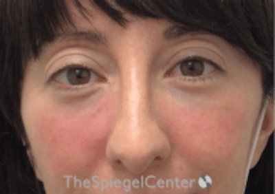 Tear Trough / Under Eye Fillers Before & After Gallery - Patient 254266 - Image 2