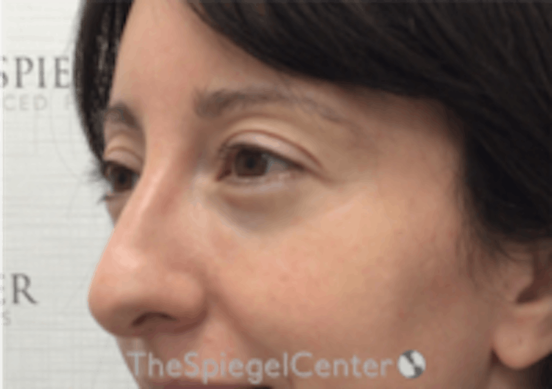 Tear Trough / Under Eye Fillers Before & After Gallery - Patient 254266 - Image 3