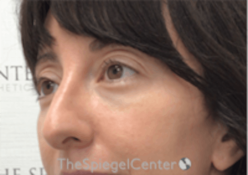 Tear Trough / Under Eye Fillers Before & After Gallery - Patient 254266 - Image 4