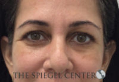 Tear Trough / Under Eye Fillers Before & After Gallery - Patient 113291 - Image 1