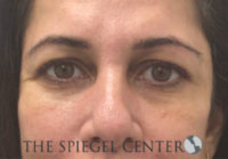 Tear Trough / Under Eye Fillers Before & After Gallery - Patient 113291 - Image 2