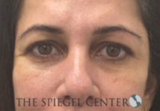 Tear Trough / Under Eye Fillers Before & After Gallery - Patient 113291 - Image 2