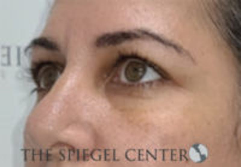 Tear Trough / Under Eye Fillers Before & After Gallery - Patient 113291 - Image 4