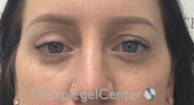 Tear Trough / Under Eye Fillers Before & After Gallery - Patient 107910 - Image 2