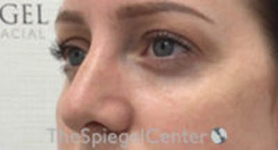 Tear Trough / Under Eye Fillers Before & After Gallery - Patient 107910 - Image 3