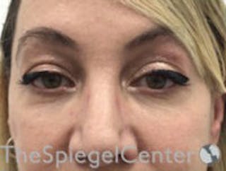 Tear Trough / Under Eye Fillers Before & After Gallery - Patient 270174 - Image 2