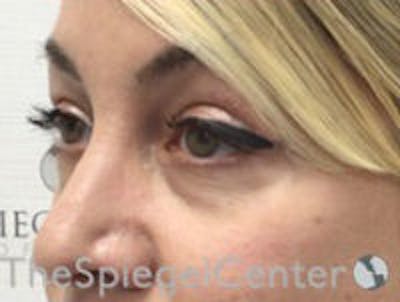 Tear Trough / Under Eye Fillers Before & After Gallery - Patient 270174 - Image 3