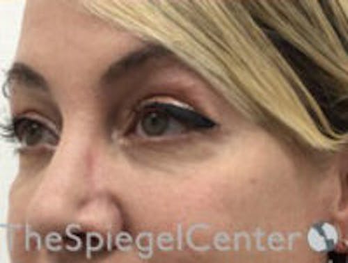 Tear Trough / Under Eye Fillers Before & After Gallery - Patient 270174 - Image 4